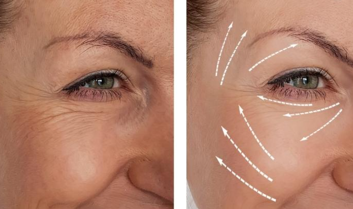 Perdida de volumen facial